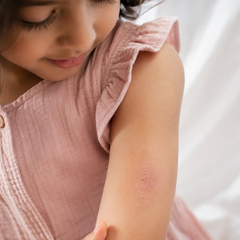Eczéma et sécheresse cutanée enfants maroc